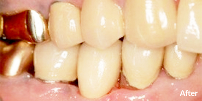 Two Dental Implants Upper Left