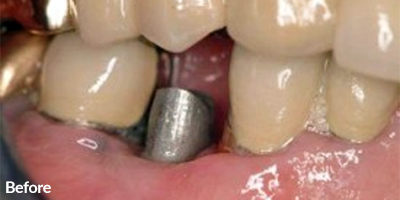 One Dental Implants Bottom Right